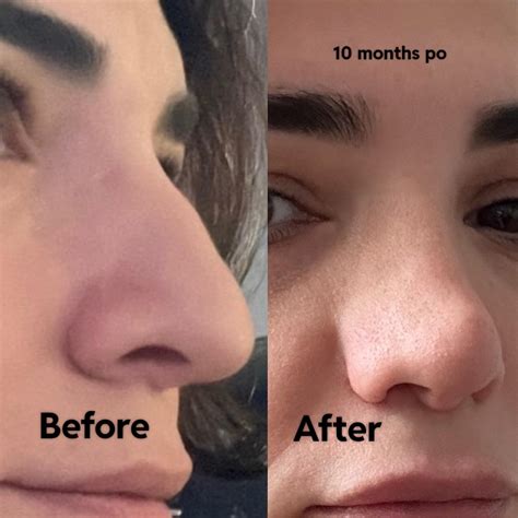 Botched by Suleyman Tas : r/PlasticSurgery