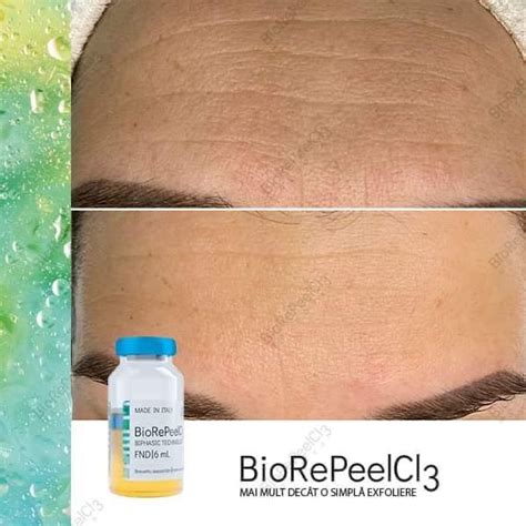 BioRePeel Cl3 - Skin Deep Treatments Yorkshire