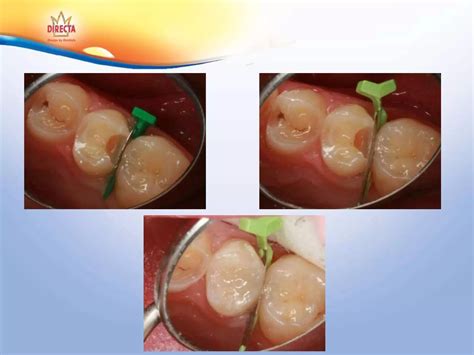 Matrices in-pediatric-restorative-dentistry | PPTX