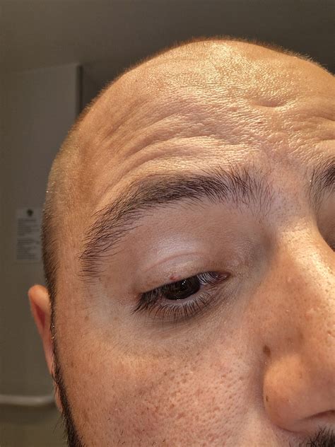 Deux boutons qui ne partent pas. - Forum Dermatologie