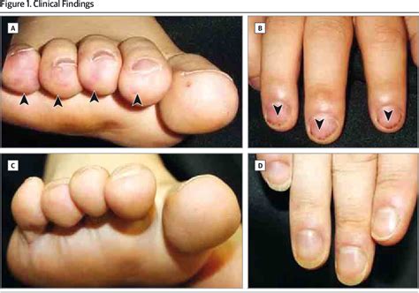 janeway lesions  osler nodes