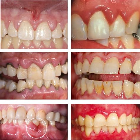 Swollen Gums: Causes, Treatment, and Prevention