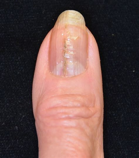 What Causes Throbbing Pain Under Fingernail at Mildred Fulcher blog