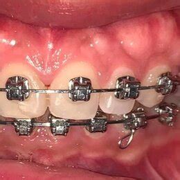 Pretreatment intraoral images showing presence of TP. | Download ... 