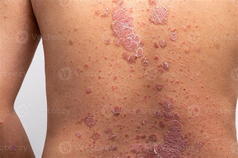 Psoriasis is that back on white background. 11026214 Stock Photo at ...