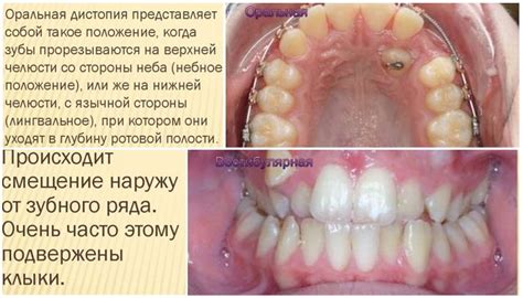 Дистопированный зуб - описание, лечение и удаление