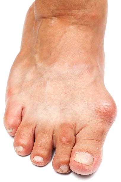 630+ Manchas Blancas En Las Uñas De Los Pies Fotografías de stock ...