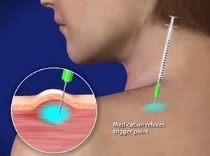 Trigger Point Injections | Phoenix Car Accident