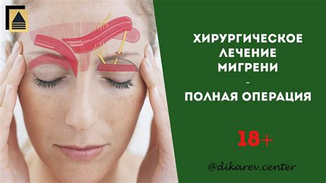 Хирургическое лечение мигрени - YouTube