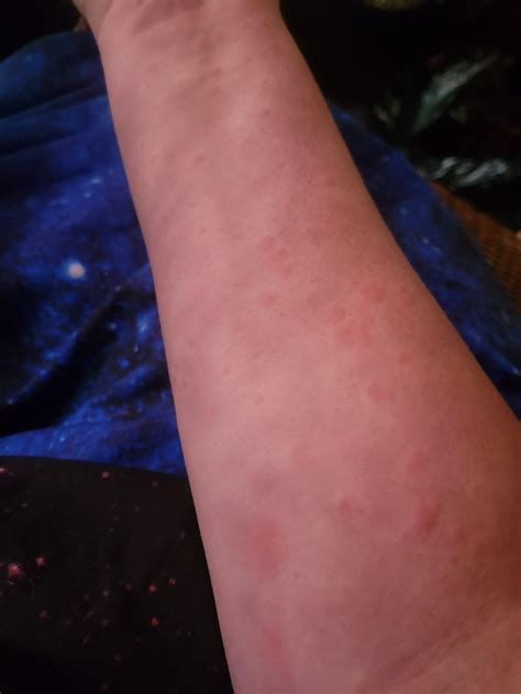 Is it just me or does sweating immediately get rid of prickly heat? : r