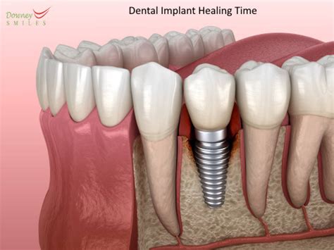 how long do dental implants take to heal