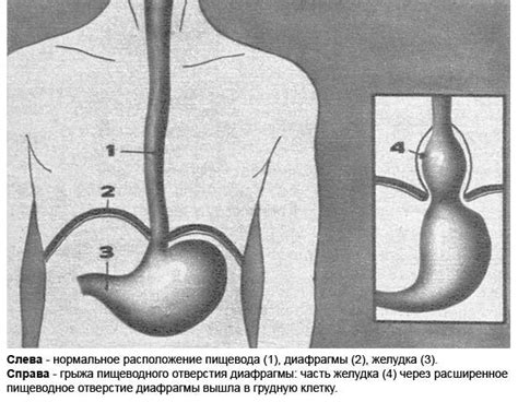 Хирургическое лечение грыжы пищеводного отверстия диафрагмы и рефлюкс ...
