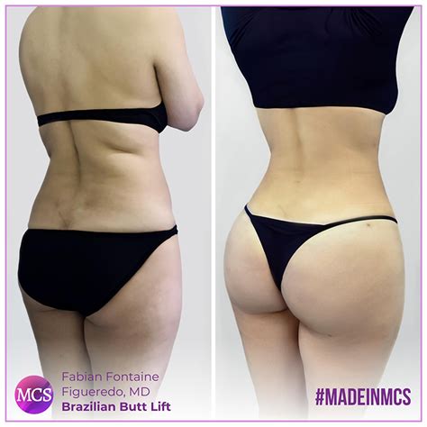 fabian fontaine md brazilian butt lift  cosmetic surgery