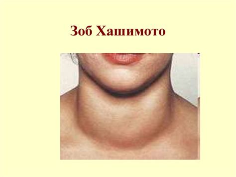 Заболевания щитовидной железе