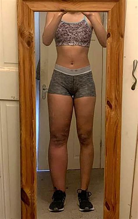 My left leg is much larger than the right — and leaks due to rare condition