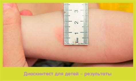 Диаскинтест для детей – результаты