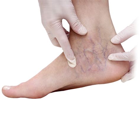 Varicose Veins - Symptoms, Causes & Conditions | Vein Health