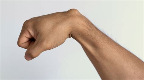 Swelling Around The Wrist Can Be Ganglion Cyst: Know All About The ...