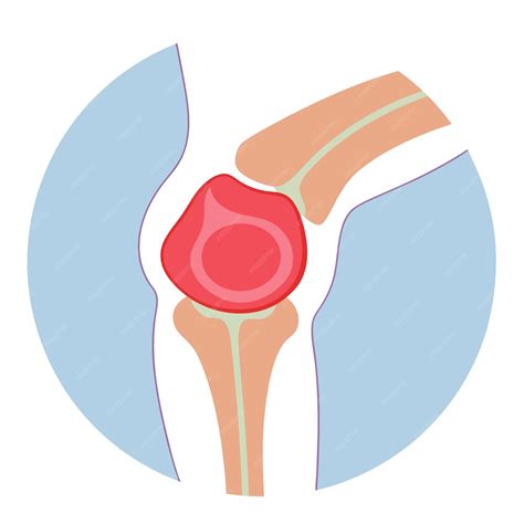 Bakers Cyst in the Knee clip art and vector design with a white