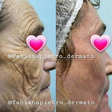 All About Phenol Peel: Is It Worth It? Risks & Results