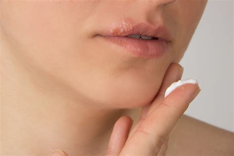 Why Does Cold Sore Appear On Lips | Lipstutorial.org