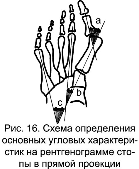Поперечное плоскостопие и деформации пальцев