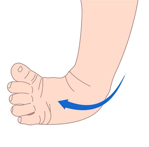 Best Clubfoot Treatment in Richmond Hill - Physio2Health