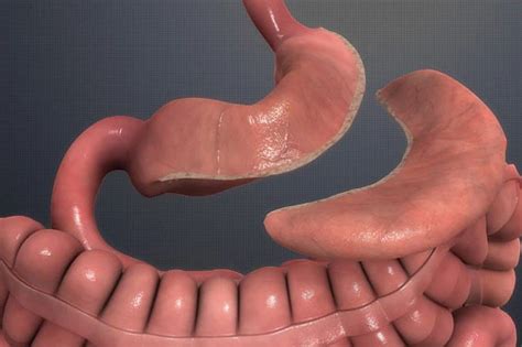 cost  gastric bypass surgery  turkey medgol