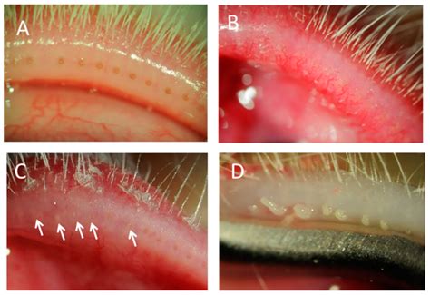 Resultado de imagen para imagenes de meibomitis | Blefaritis, Anatomia🍉 ...