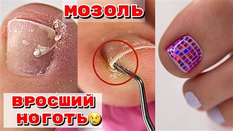 ВРОСШИЙ НОГОТЬ😢 Огромная подногтевая мозоль / Педикюр на себе / как ...
