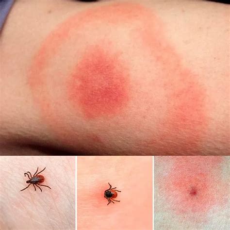 Tick Bite Treatment – What To Do, First Aid, Home Remedies and Care ...