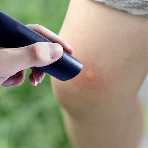 Electronic Mosquito Bite Anti-itch Pen Relief Burning Pain & Swelling ...