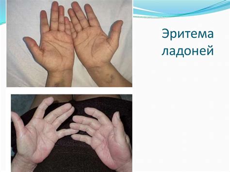 Виды сыпей при covid-19 - презентация онлайн
