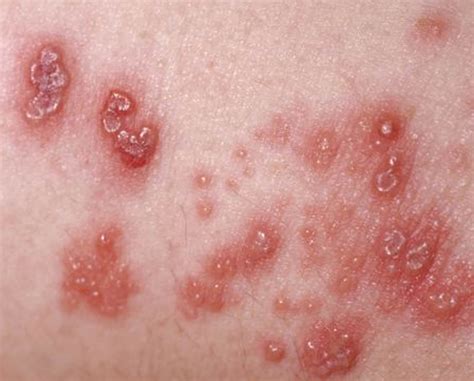 Shingles Rashes Pictures _ What Shingles Look Like – IRMT