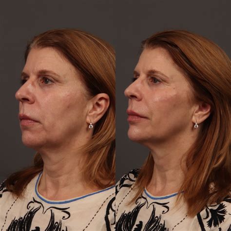 face filler price 1