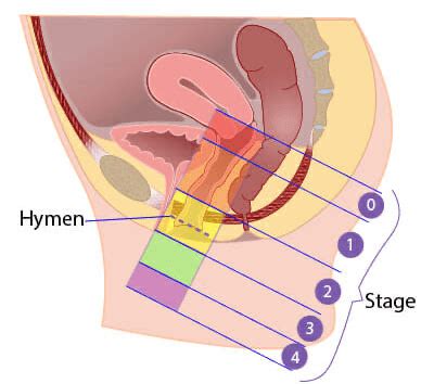 Cystocele Grading