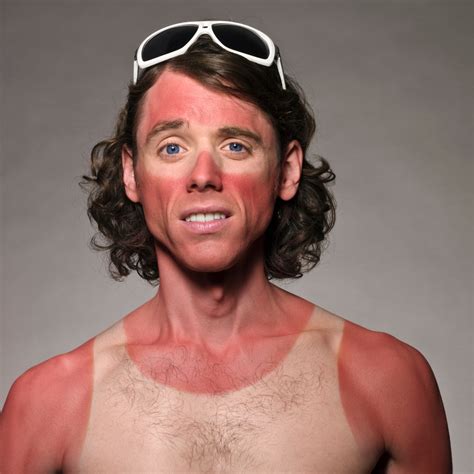 sunburn elevation med spa