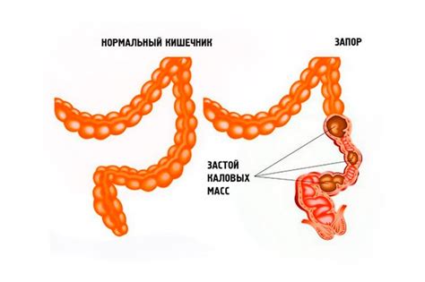 Запор: причины, симптомы, диагностика и лечение