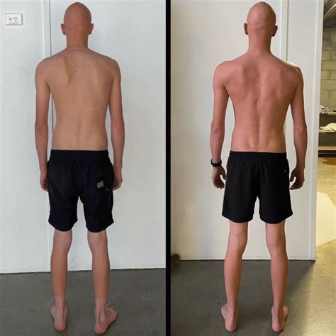 Scoliosis Treatment & Posture Correction | Brisbane Experts