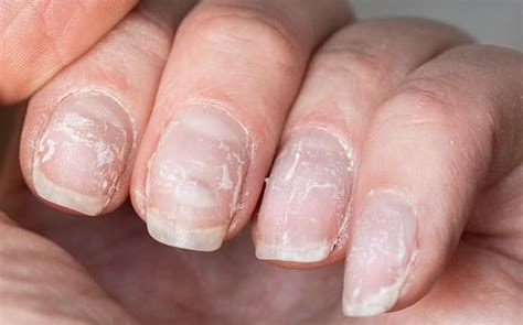 Cómo prevenir y tratar las estrías en las uñas- Grupo Milenio