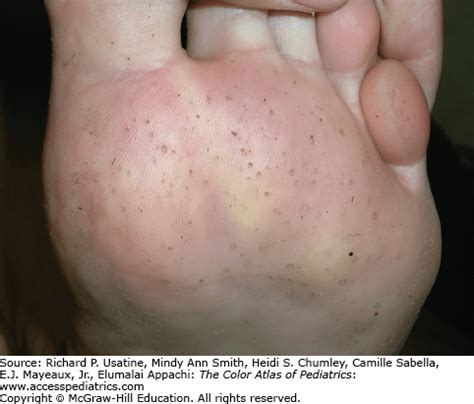 Pitted Keratolysis | Obgyn Key