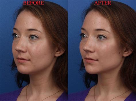 InfluencerGoneWild's Before & After: A Plastic Surgery Nightmare? Image 16