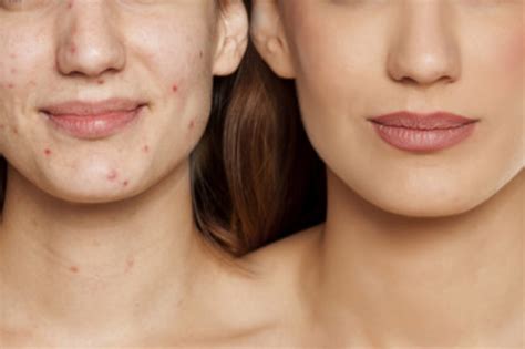 Acne Treatment - Pinewoods Clinic
