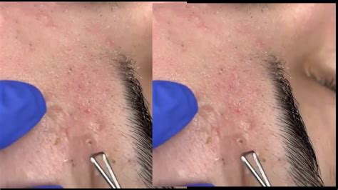 Unbelievable Blackhead Removal 2024: Get Rid of Blackheads FAST! - jemblll