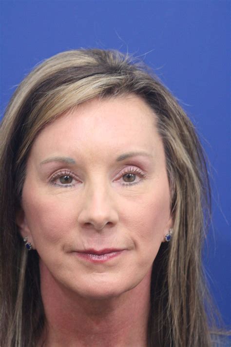 Endoscopic Face Lift Procedure at Alyssa Massy-greene blog