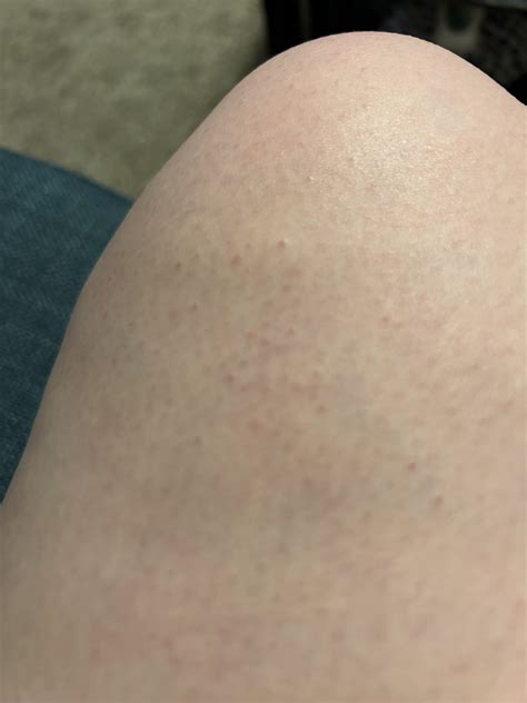 What are these raised red bumps on both knees? : r/DermatologyQuestions