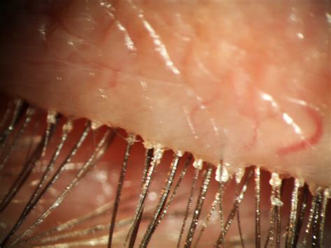 can mold mites get in your hair 4