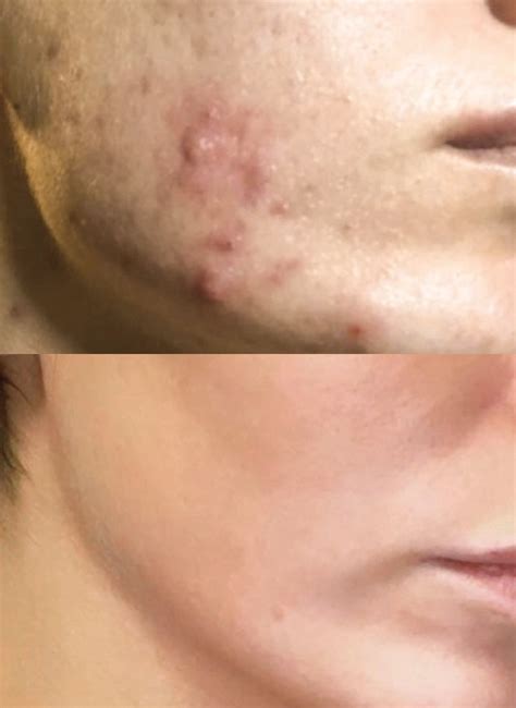BBL Acne Treatment for Clear, Beautiful Skin | Daydreams Spa