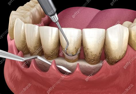 open curettage scaling  root planing conventional periodontal