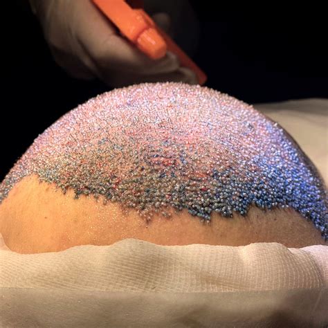 duracao transplante capilar em bh clinica rejuvenesce